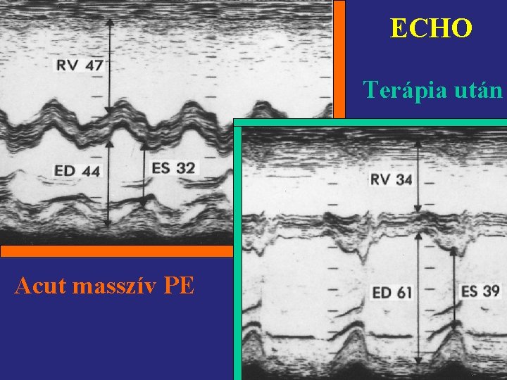 ECHO Terápia után Acut masszív PE 