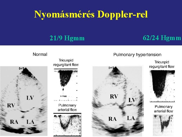 Nyomásmérés Doppler-rel 21/9 Hgmm 62/24 Hgmm 