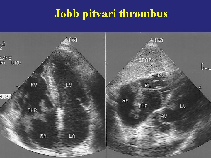 Jobb pitvari thrombus 