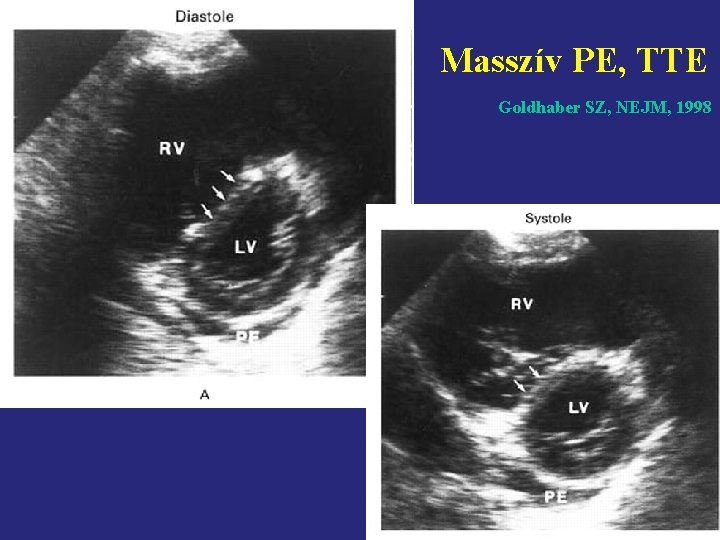 Masszív PE, TTE Goldhaber SZ, NEJM, 1998 