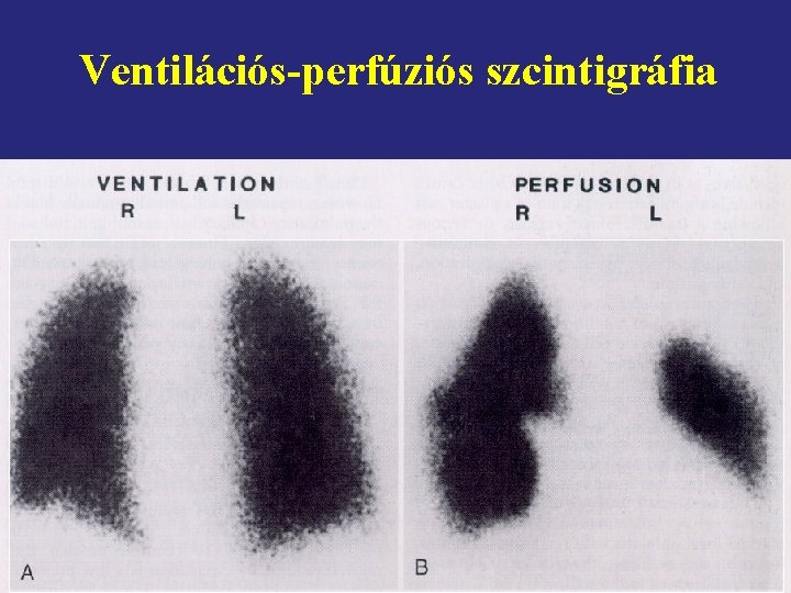 Ventilációs-perfúziós szcintigráfia 