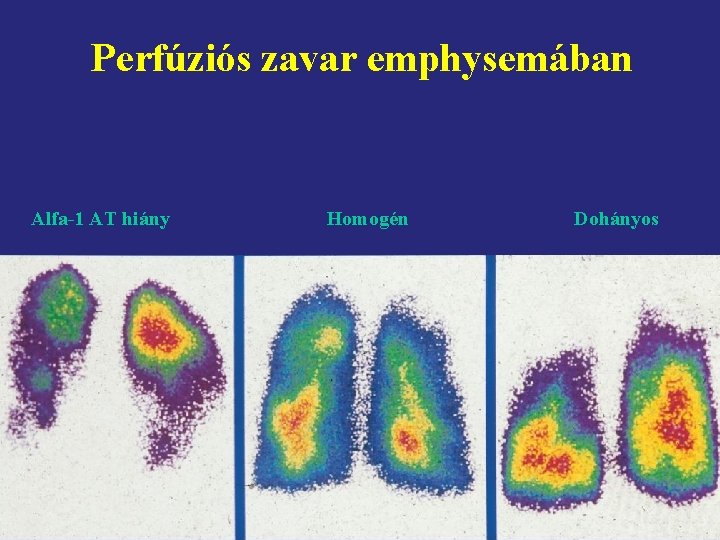 Perfúziós zavar emphysemában Alfa-1 AT hiány Homogén Dohányos 