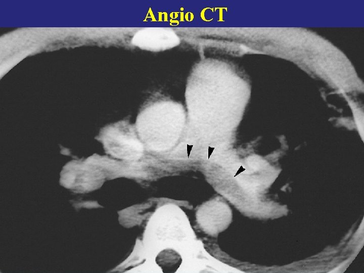 Angio CT 