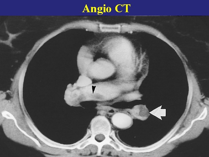 Angio CT 