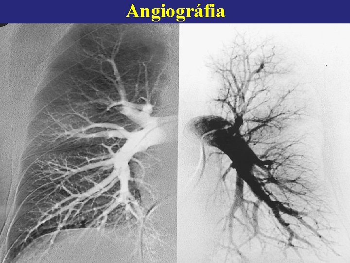 Angiográfia 