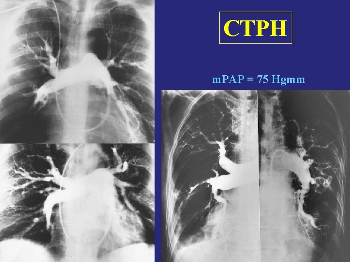 CTPH m. PAP = 75 Hgmm 