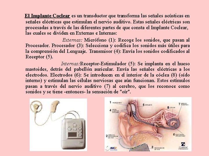  El Implante Coclear es un transductor que transforma las señales acústicas en señales