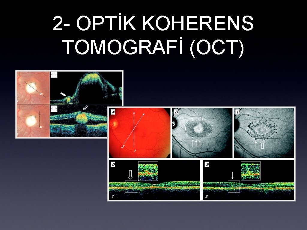 2 - OPTİK KOHERENS TOMOGRAFİ (OCT) 