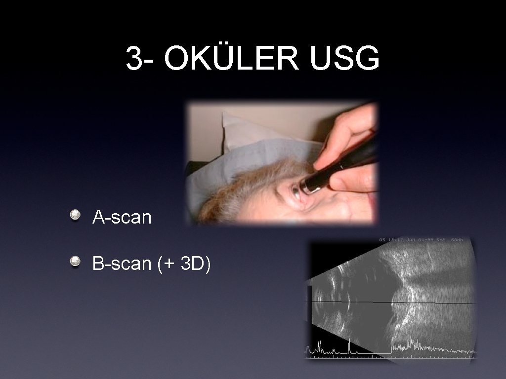 3 - OKÜLER USG A-scan B-scan (+ 3 D) 