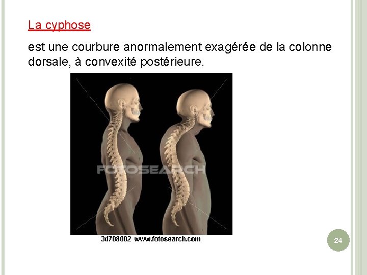 La cyphose est une courbure anormalement exagérée de la colonne dorsale, à convexité postérieure.