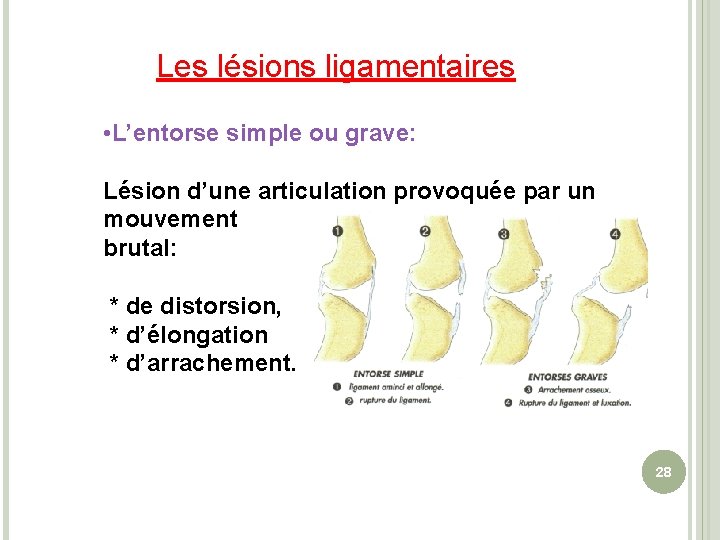 Les lésions ligamentaires • L’entorse simple ou grave: Lésion d’une articulation provoquée par un