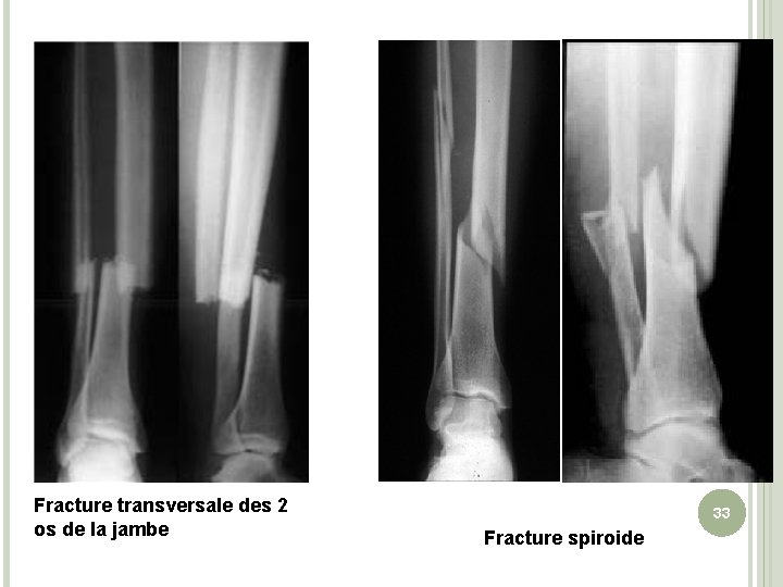 Fracture transversale des 2 os de la jambe 33 Fracture spiroide 