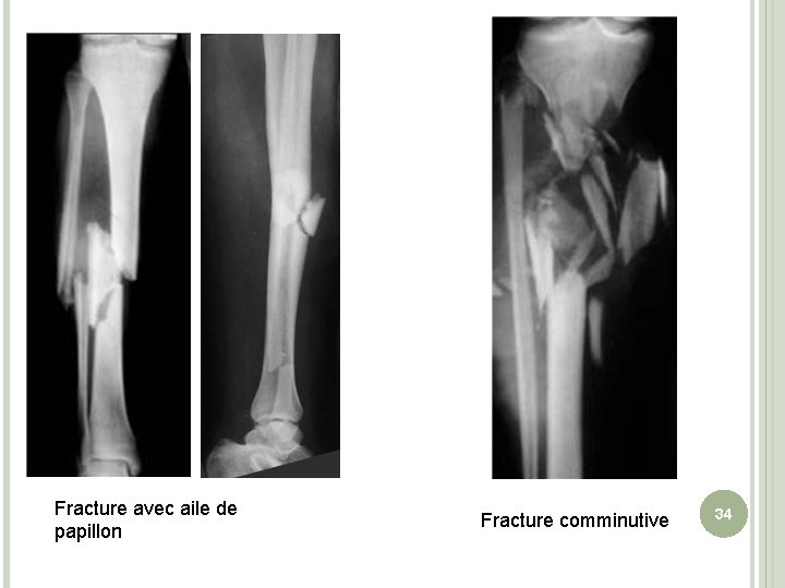 Fracture avec aile de papillon Fracture comminutive 34 