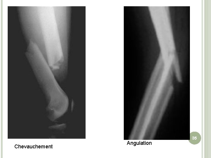 Chevauchement Angulation 35 