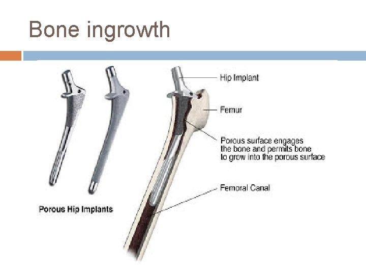 Bone ingrowth 
