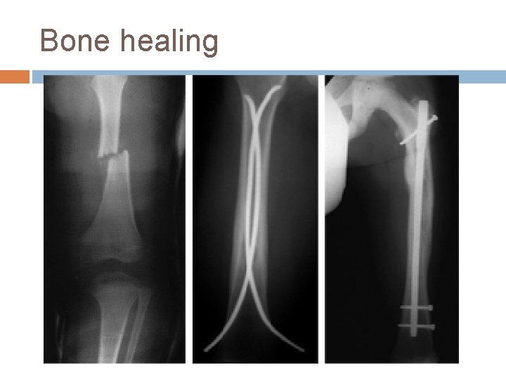 Bone healing 