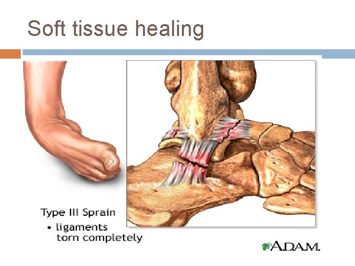 Soft tissue healing 