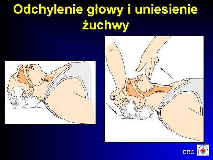 Odchylenie głowy i uniesienie żuchwy ERC 