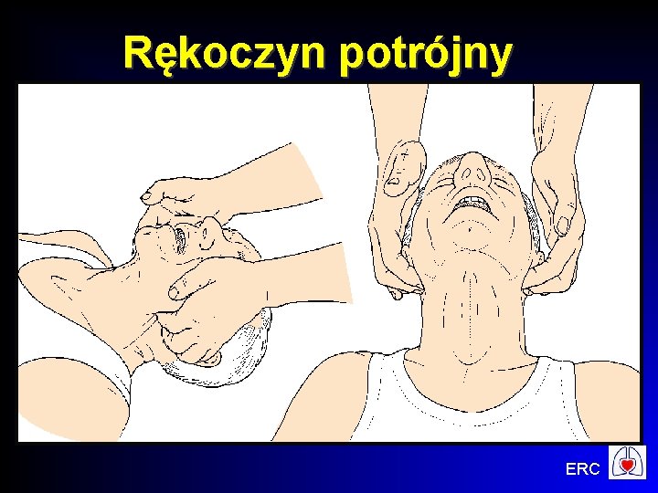 Rękoczyn potrójny ERC 