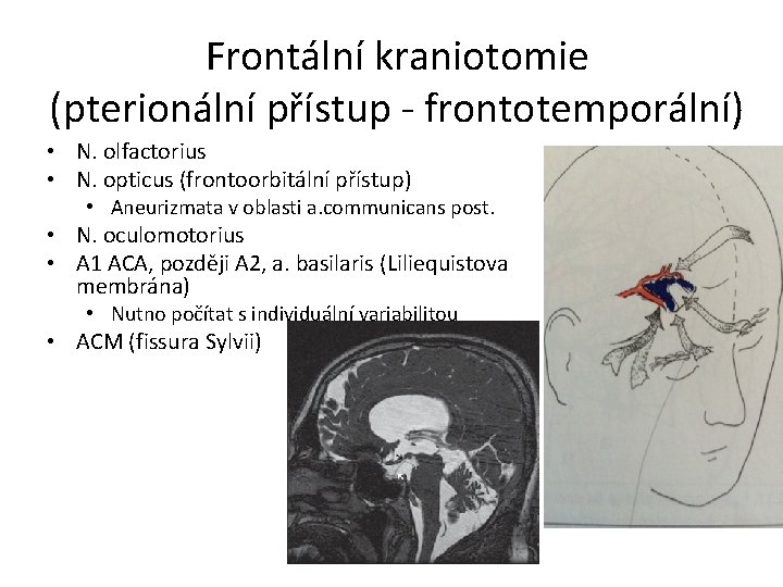 Frontální kraniotomie (pterionální přístup - frontotemporální) • N. olfactorius • N. opticus (frontoorbitální přístup)