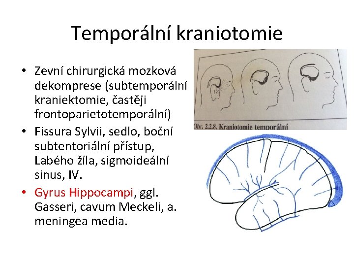 Temporální kraniotomie • Zevní chirurgická mozková dekomprese (subtemporální kraniektomie, častěji frontoparietotemporální) • Fissura Sylvii,