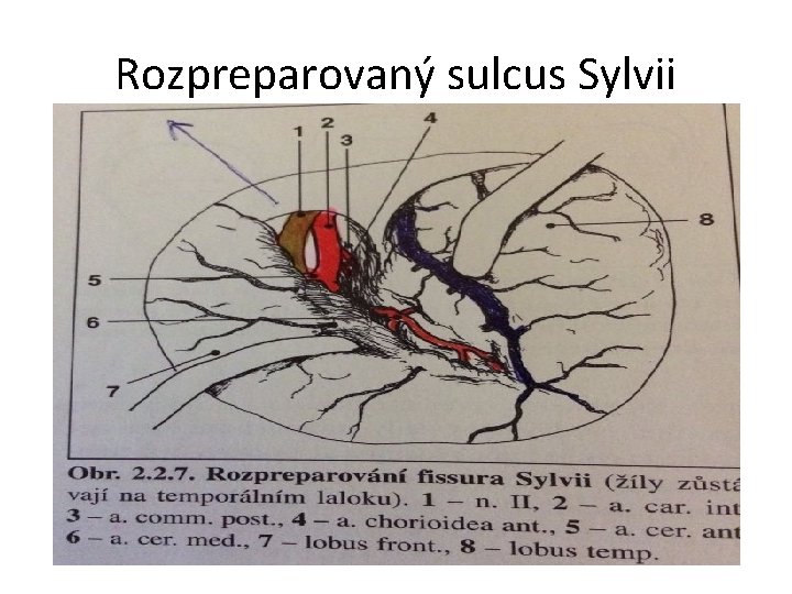 Rozpreparovaný sulcus Sylvii 
