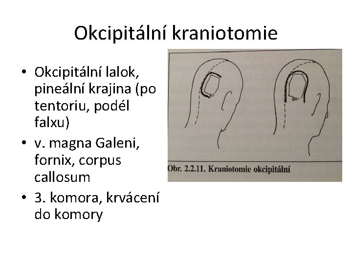 Okcipitální kraniotomie • Okcipitální lalok, pineální krajina (po tentoriu, podél falxu) • v. magna