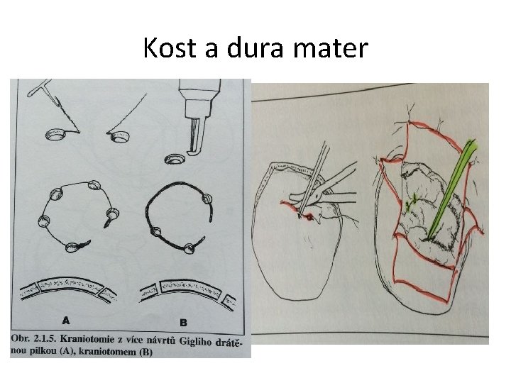 Kost a dura mater 