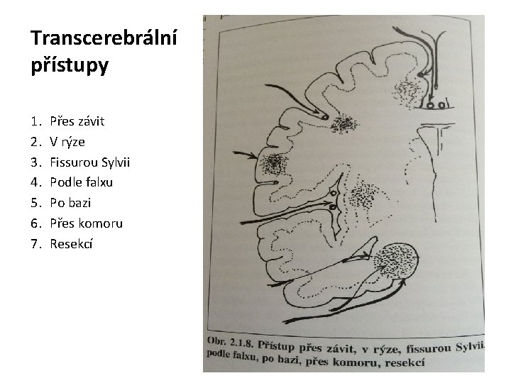 Transcerebrální přístupy 1. 2. 3. 4. 5. 6. 7. Přes závit V rýze Fissurou