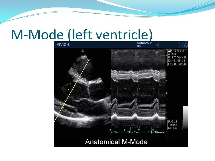 M-Mode (left ventricle) 