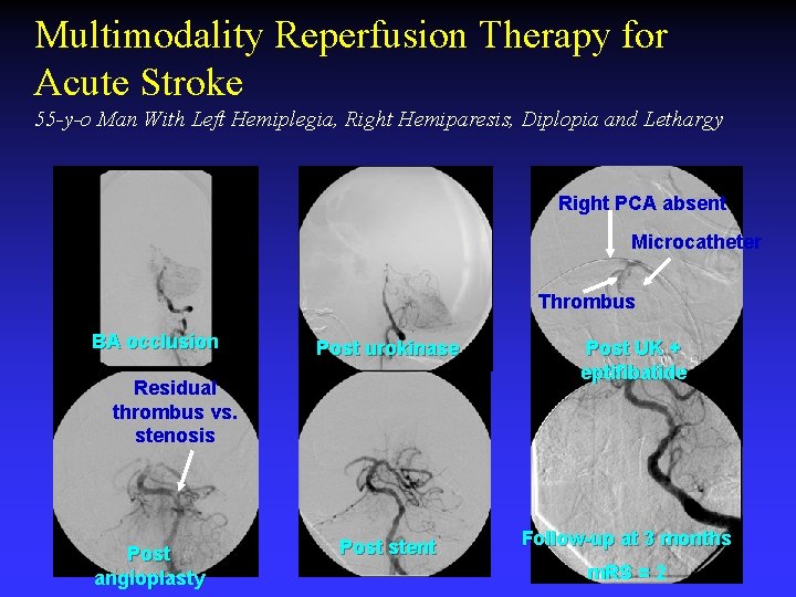Multimodality Reperfusion Therapy for Acute Stroke 55 -y-o Man With Left Hemiplegia, Right Hemiparesis,