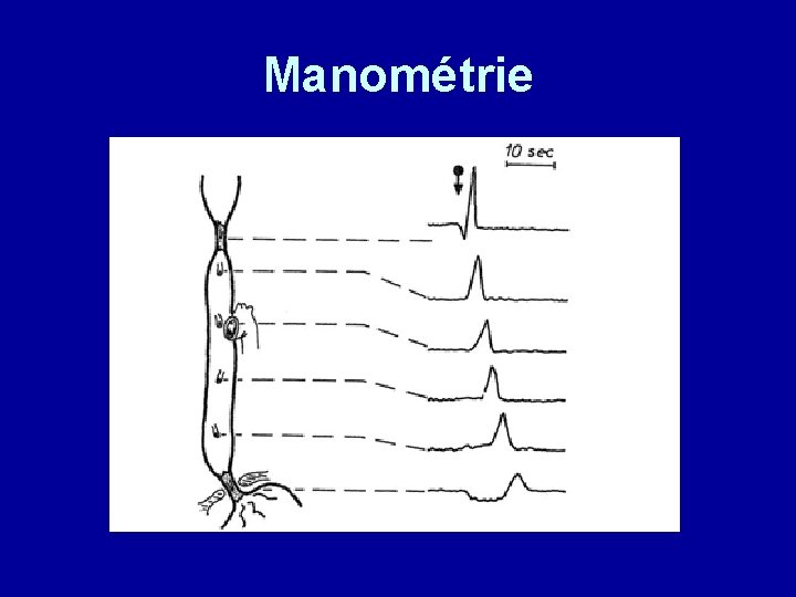 Manométrie 