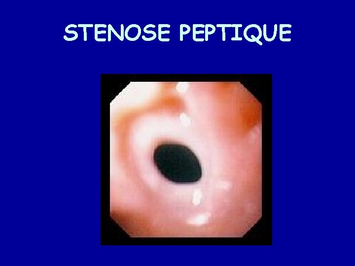 STENOSE PEPTIQUE 