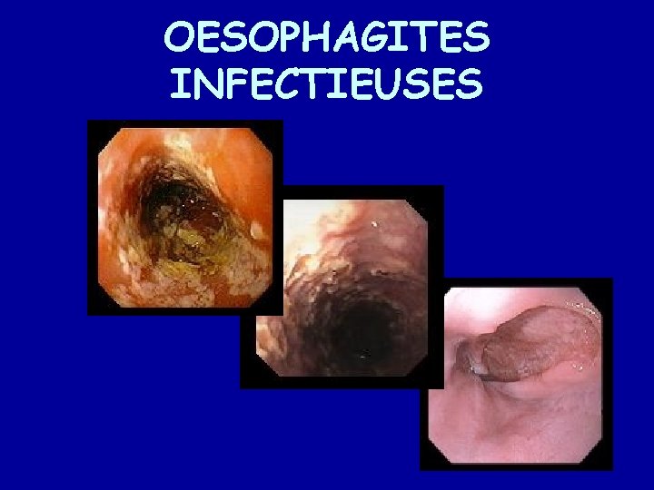 OESOPHAGITES INFECTIEUSES 