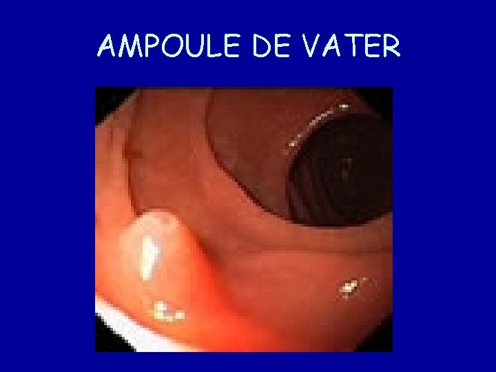 AMPOULE DE VATER 
