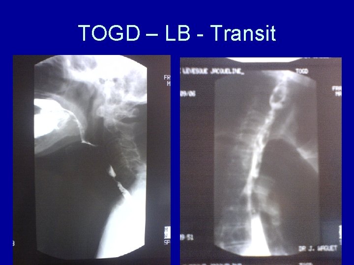 TOGD – LB - Transit 
