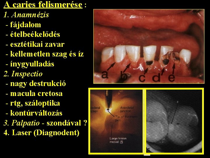 A caries felismerése : 1. Anamnézis - fájdalom - ételbeékelődés - esztétikai zavar -