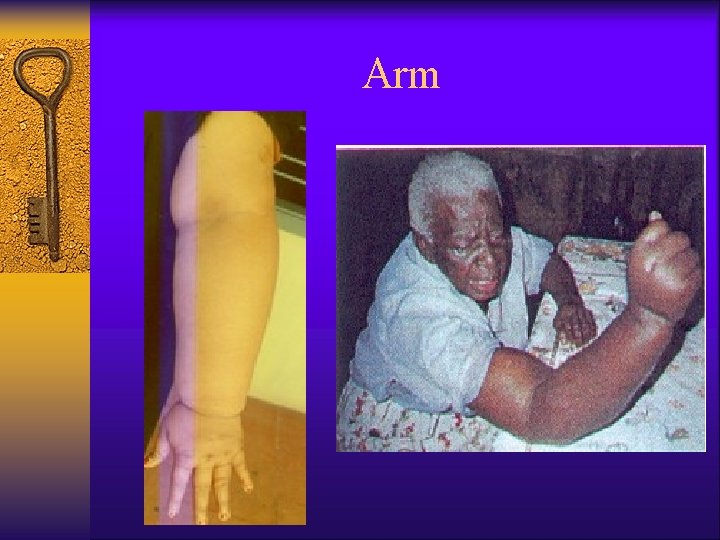 Arm 
