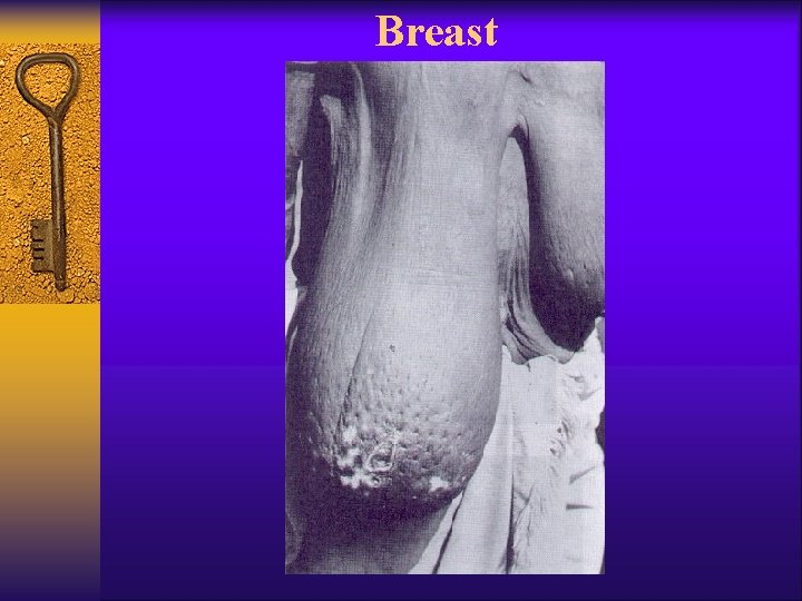 Breast 