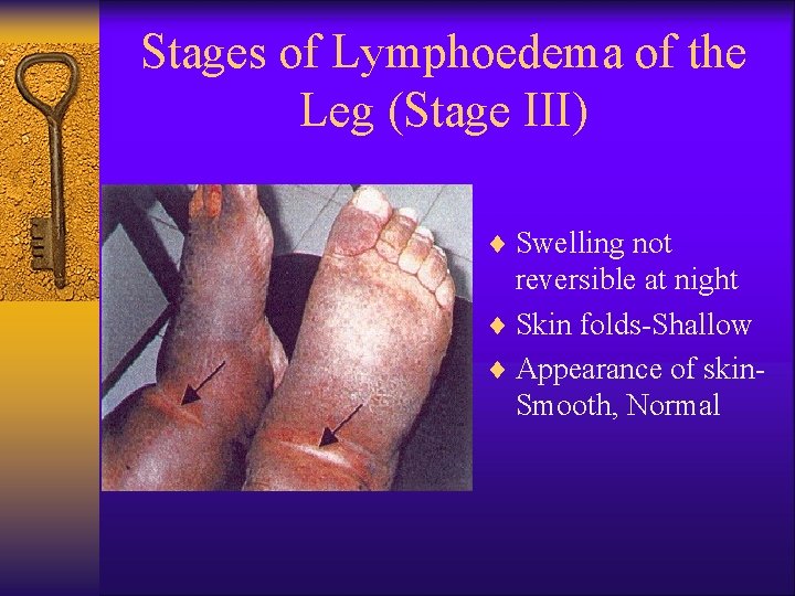 Stages of Lymphoedema of the Leg (Stage III) ¨ Swelling not reversible at night