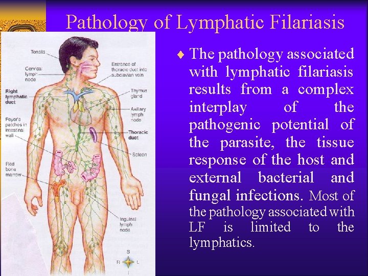 Pathology of Lymphatic Filariasis ¨ The pathology associated with lymphatic filariasis results from a
