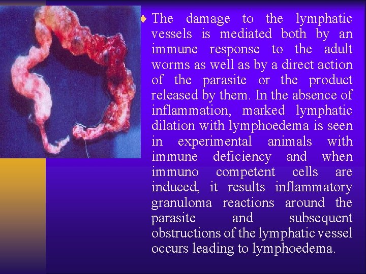 ¨ The damage to the lymphatic vessels is mediated both by an immune response