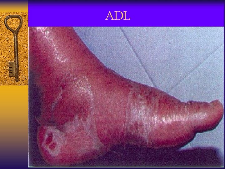 ADL 