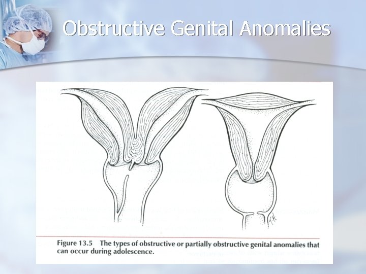 Obstructive Genital Anomalies 