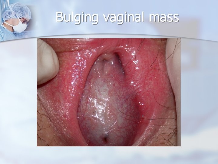 Bulging vaginal mass 