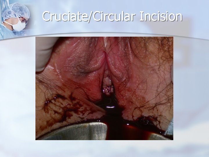 Cruciate/Circular Incision 