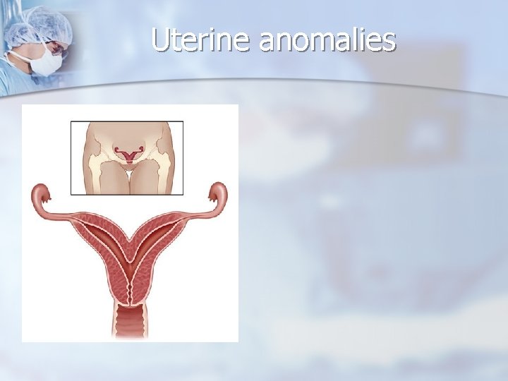 Uterine anomalies 