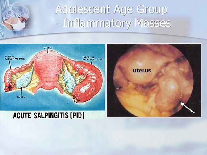 Adolescent Age Group - Inflammatory Masses 