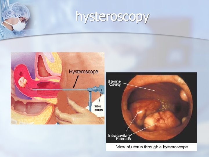 hysteroscopy 