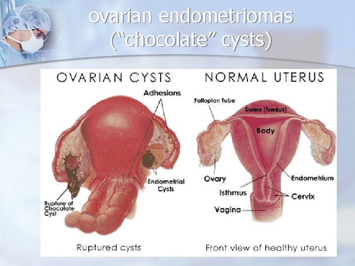 ovarian endometriomas (“chocolate” cysts) 